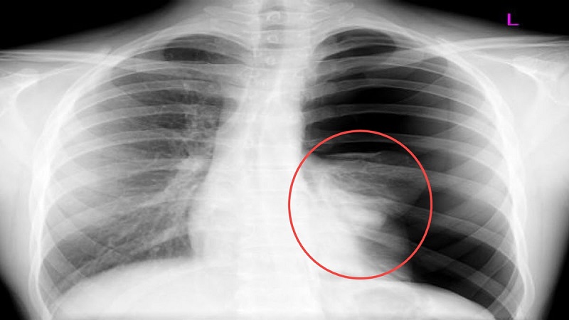 Chụp X-quang phổi thẳng và nghiêng chẩn đoán tràn dịch màng phổi